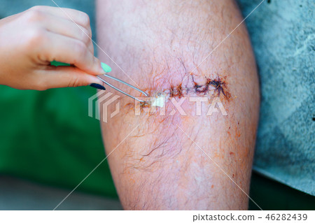 extraction of drainage from wound with tweezers 46282439