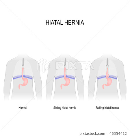 Hiatal hernia 46354412