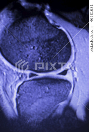 MRI knee meniscus tear scan MRI knee meniscus tear scan 46381681
