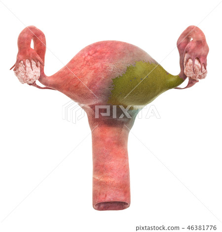 Uterine diseases concept. 3D rendering 46381776