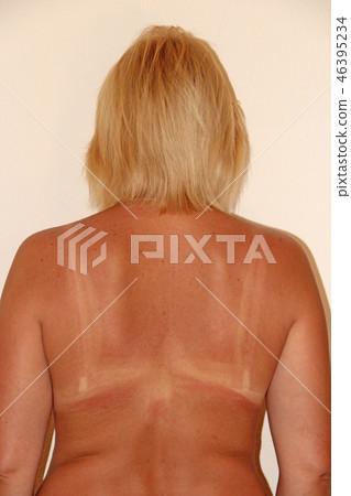 Back burnt after sunburn. Female body. Back burnt after sunburn. Female body. 46395234