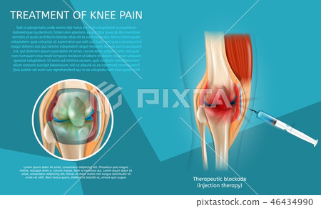 Realistic Illustration Treatment of Knee Pain 46434990