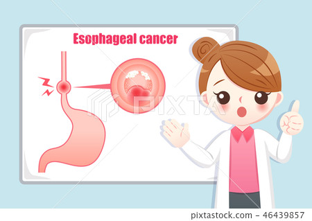 Prevention esophageal cancer Prevention esophageal cancer 46439857