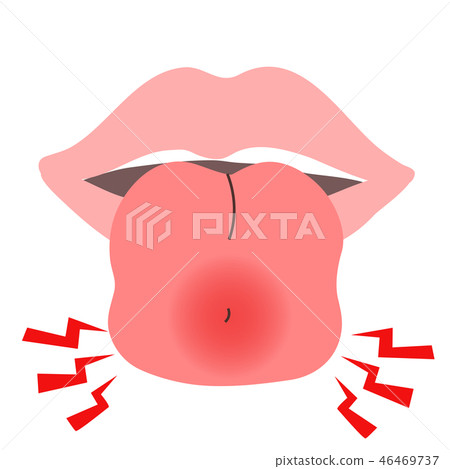 Pierced Tongue Suppuration Swollen Stock Illustration 46469737 Pixta