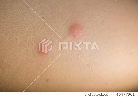 Insect bites on female hand 46477901