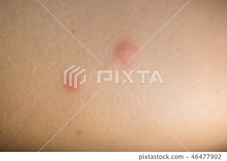 Insect bites on female hand Insect bites on female hand 46477902