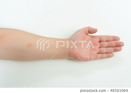Tuberculin reaction test Tuberculin reaction test 46581069