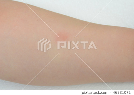 Tuberculin reaction test up 46581071