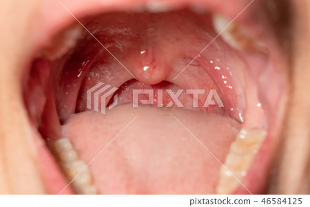 Sore throat with throat swollen. Open mouth. 46584125