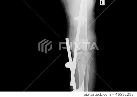 X-ray fracture leg with implant external fixation. 46592292