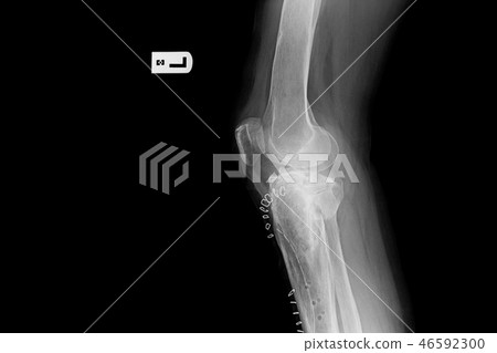 internal of left leg fixed with plate and screws. 46592300