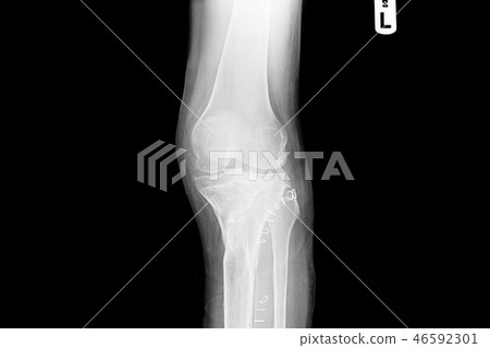 internal of left leg fixed with plate and screws. 46592301
