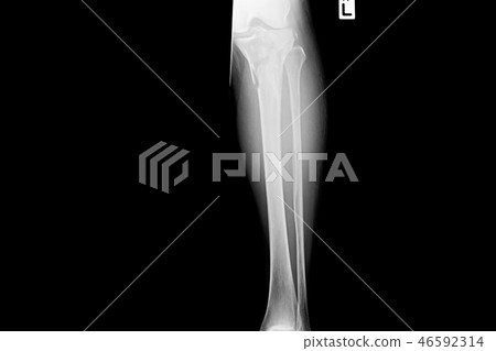 Show image of tibia and fibula left lateral 46592314