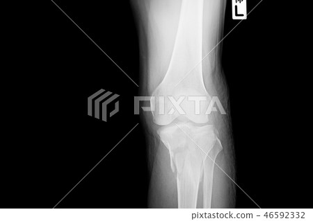 film X-ray image left Knee. 46592332