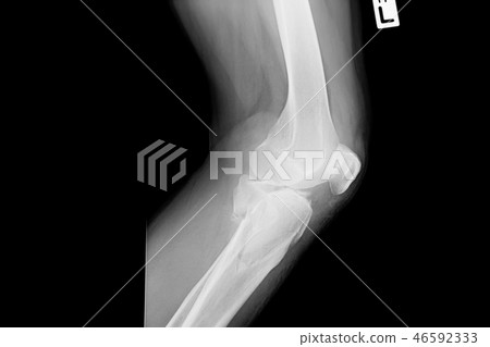 film X-ray image left Knee. 46592333