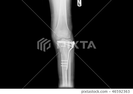 internal of left leg fixed with plate and screws. 46592363
