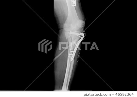 internal of left leg fixed with plate and screws. 46592364
