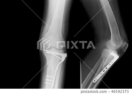 x-ray both leg and show external fixation of them. x-ray both leg and show external fixation of them. 46592373