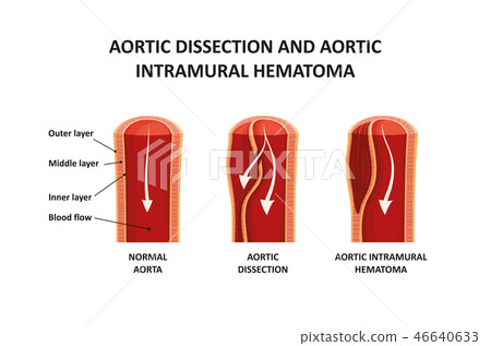 Aortic dissection and aortic intramural hematoma 46640633
