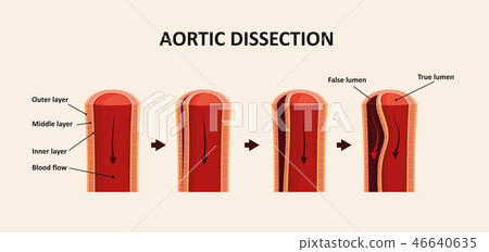 Aortic Dissection, Aortic Aneurysm Aortic Dissection, Aortic Aneurysm 46640635