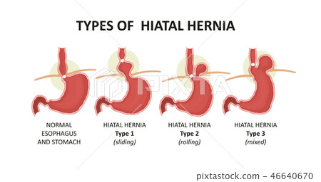 Hiatal Hernia Types