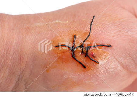 3 black stitches over caucasian skin with healing liquid 46692447