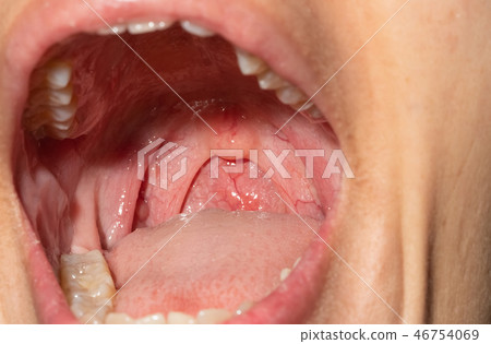 Sore throat with throat swollen. Open mouth  46754069