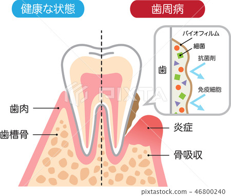 Healthy teeth and periodontal disease biofilms cross section 46800240