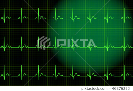 ECG image 46876253