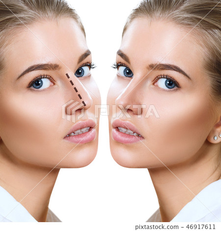 Female nose before and after cosmetic surgery. Female nose before and after cosmetic surgery. 46917611
