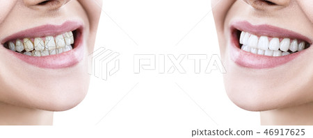 Teeth of young woman before and after treatment. 46917625