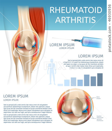 Infographic Treatment Method Rheumatoid Arthritis 46930936