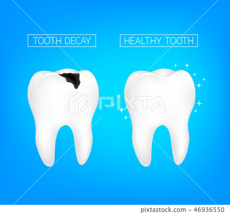 Caries and healthy tooth Comparision. Caries and healthy tooth Comparision. 46936550