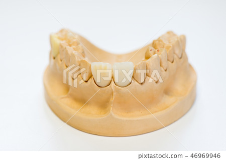 Dental gypsum model  46969946