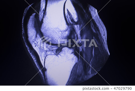 MRI knee meniscus tear scan MRI knee meniscus tear scan 47029790