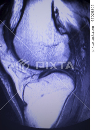 MRI knee meniscus tear scan MRI knee meniscus tear scan 47029805