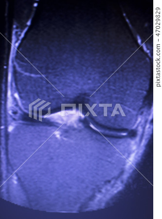 MRI knee meniscus tear scan MRI knee meniscus tear scan 47029829