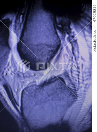 MRI knee meniscus tear scan MRI knee meniscus tear scan 47029833