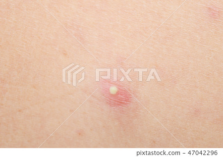 pimple 47042296
