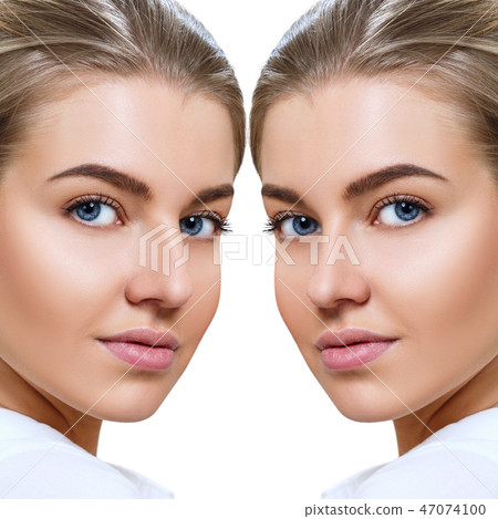 Female nose before and after cosmetic surgery. Female nose before and after cosmetic surgery. 47074100