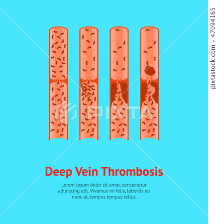 Cartoon Deep Vein Thrombosis Card Poster. Vector Cartoon Deep Vein Thrombosis Card Poster. Vector 47094165