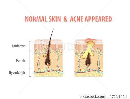 normal skin acne