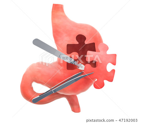Stomach surgery concept, 3D rendering Stomach surgery concept, 3D rendering 47192003