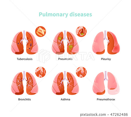 Pulmonary disease vector 47262486