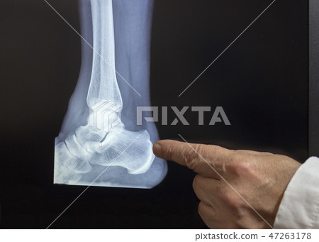 An xray of a heel with a doctors hand An xray of a heel with a doctors hand 47263178