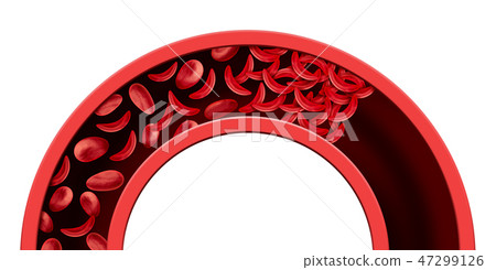 Sickle Cell Blood Vessel Blockage 47299126