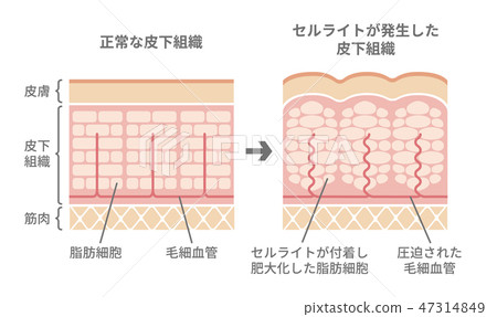 健康皮膚和脂肪團產生的皮膚的部分比較的例證 47314849