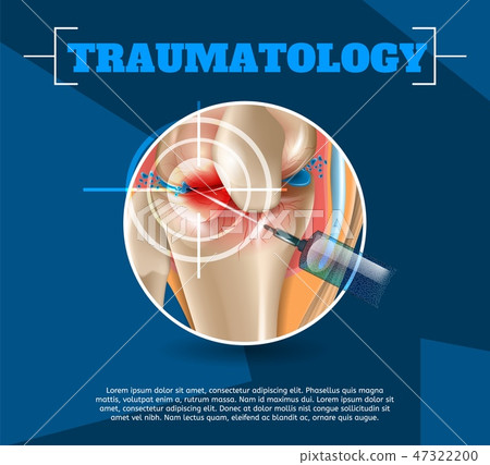 Realistic Illustration Traumatology Medicine in 3d Realistic Illustration Traumatology Medicine in 3d 47322200