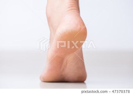 Cracks on Heels with bad skin covered.  47370378
