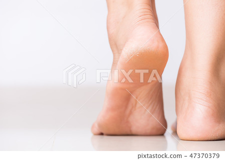 Cracks on Heels with bad skin covered.  47370379
